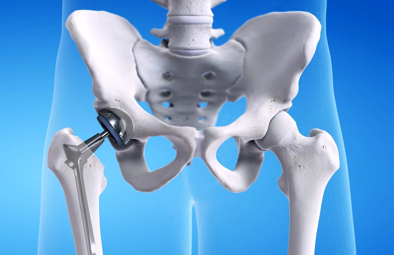 Best Total Hip Replacement Doctor in Thane | Dr. Shashank Gabhe